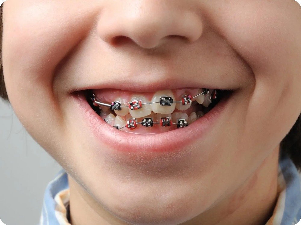 Kids Dental Corner | Orthodontic Evaluation & Treatment
